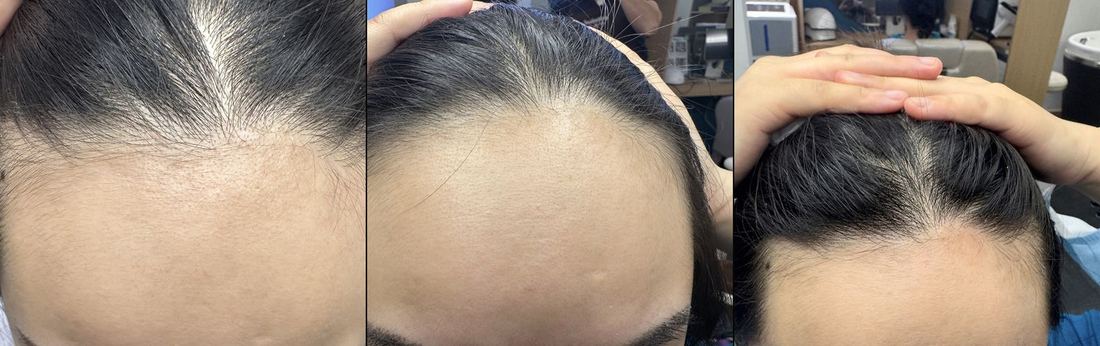 左額角 · 32 歲 · 以痣定位 · 28 天（3/3）/ Left temple · 32 · aligned on a mole · 28 days