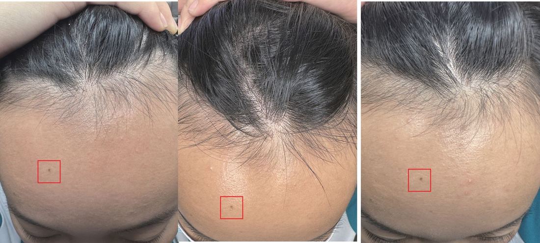 另一位女士 · 三個角度 · 10 天（3/3）/ Another woman · three angles · 10 days