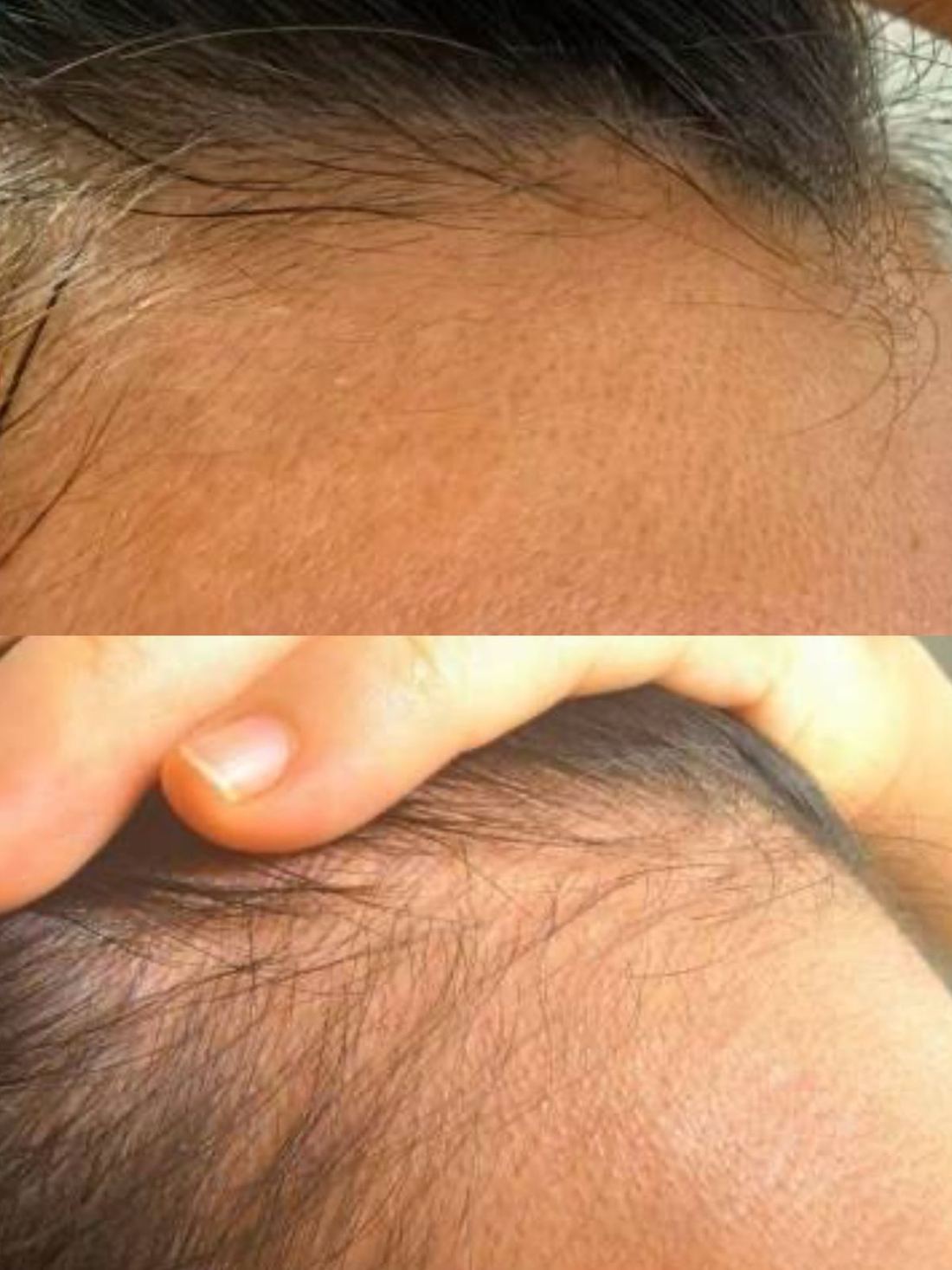 另一位女士 · 髮際線 · 21 天（2/2）/ Another woman · hairline · 21 days