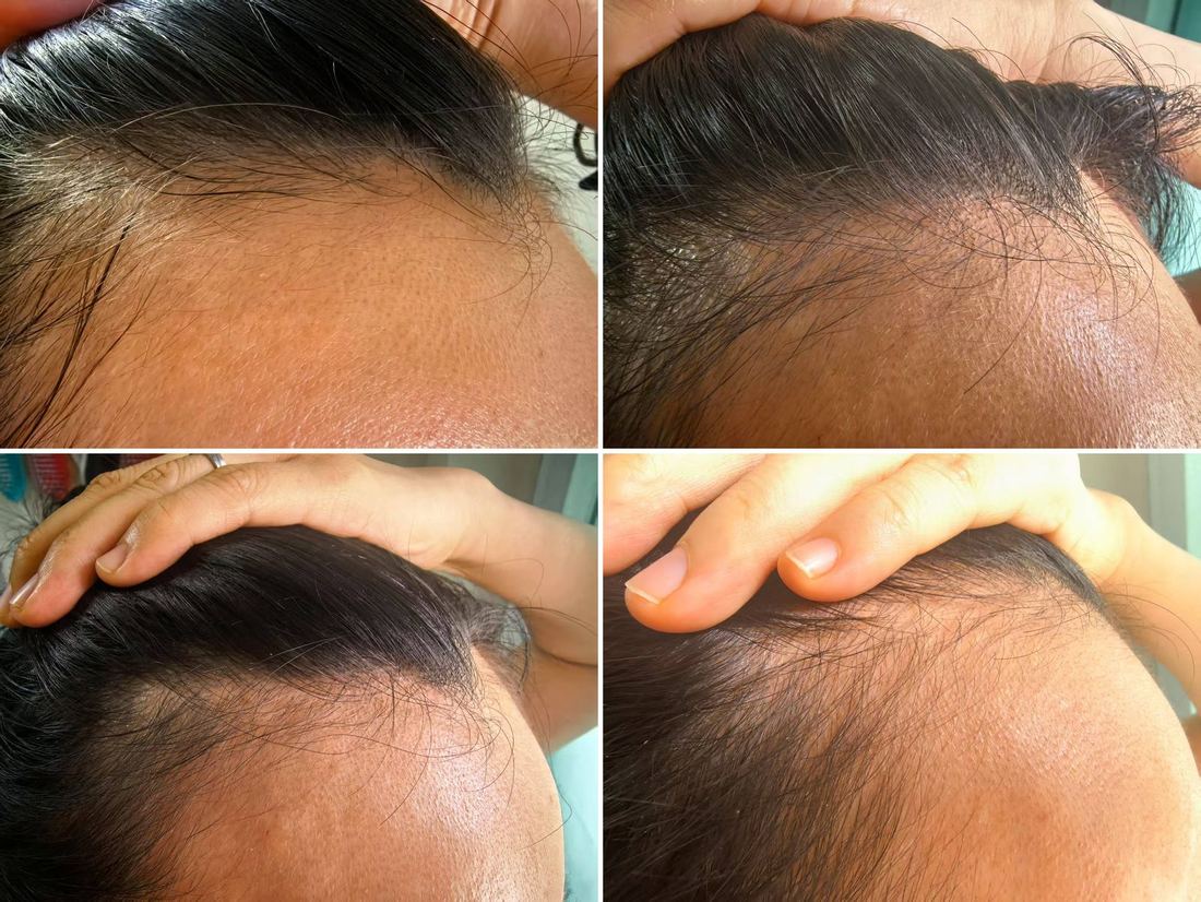 另一位女士 · 髮際線 · 21 天（1/2）/ Another woman · hairline · 21 days