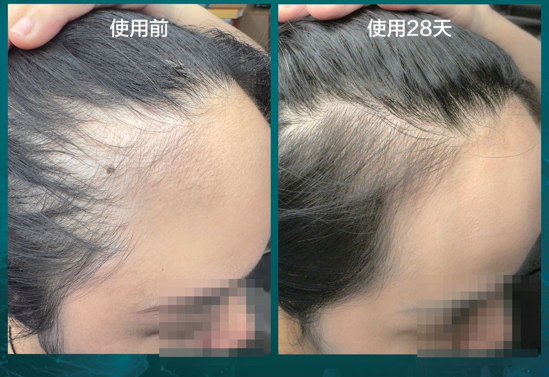 左額角 · 以痣定位 · 28 天（2/2）/ Left temple · aligned on a mole · 28 days