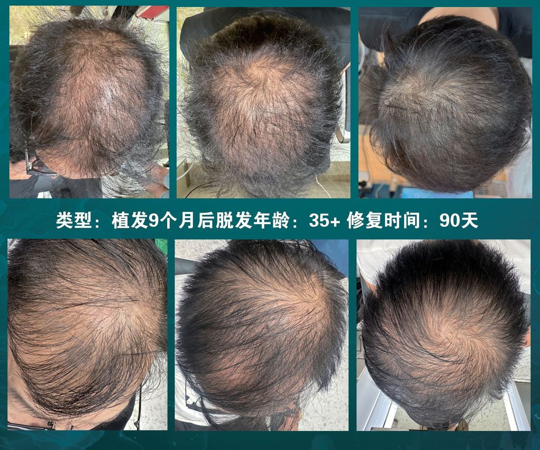 植髮九個月後再次變稀 · 35 歲以上（1/1）/ Thinning again nine months after a transplant · over 35