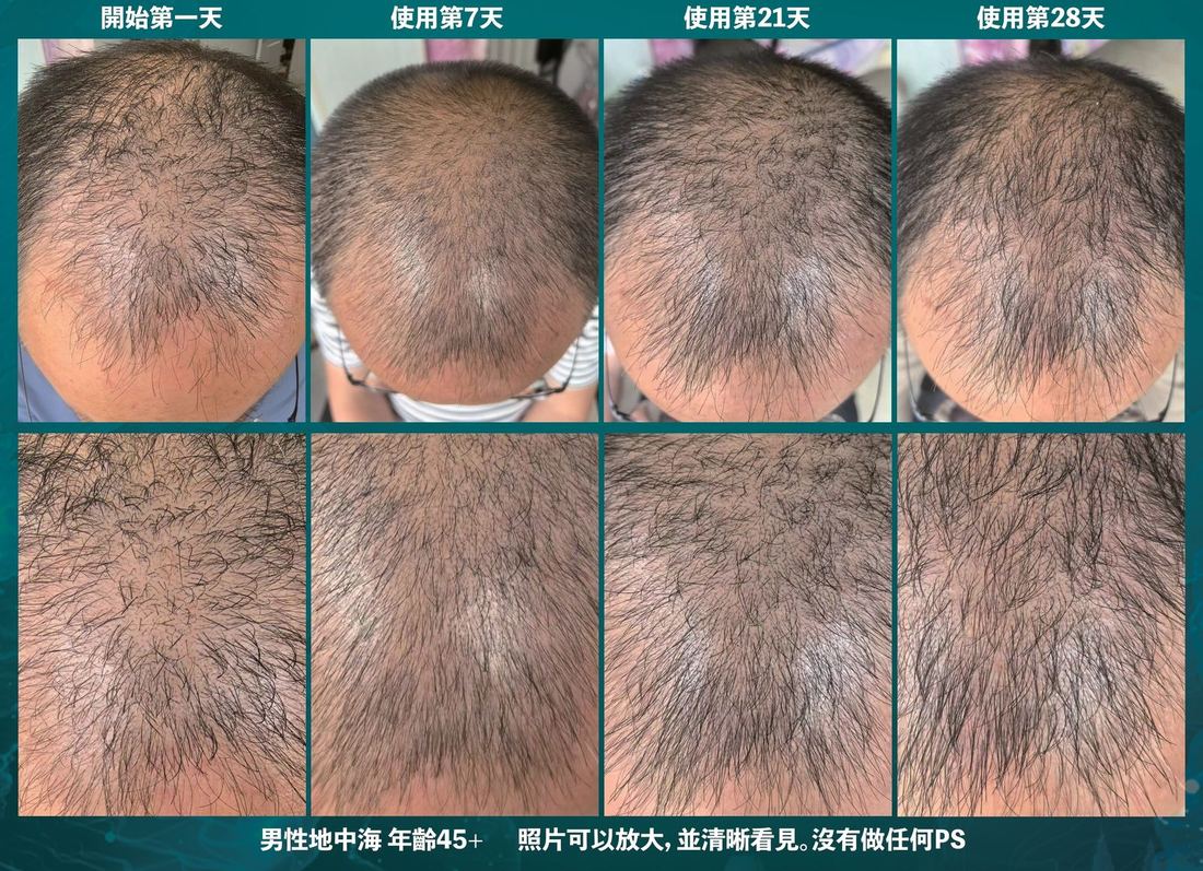 頭頂 · 45 歲以上 · 28 天（1/1）/ Crown · over 45 · 28 days