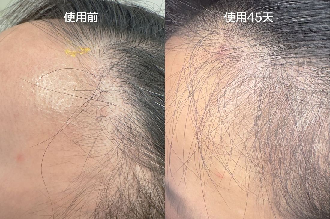 前額 · 45 天（1/1）/ Forehead · 45 days