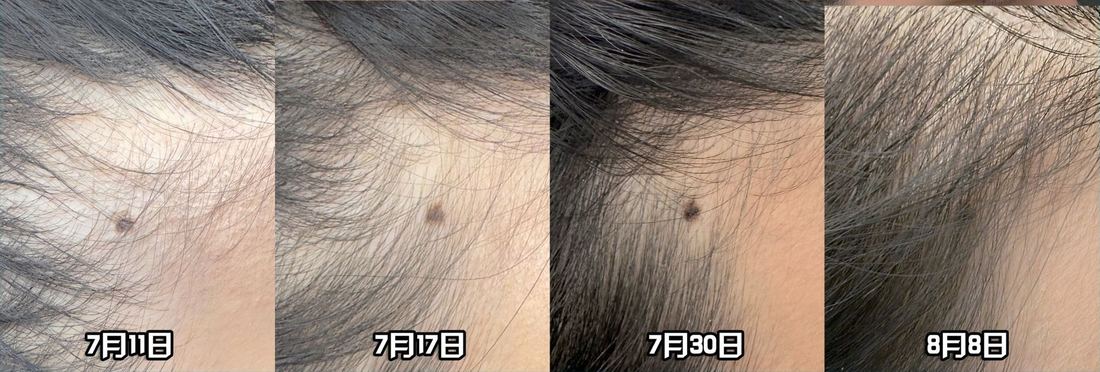 女士左額角，以痣定位，第 0、6、19、28 天 / Woman's left temple aligned on a mole, day 0, 6, 19, 28