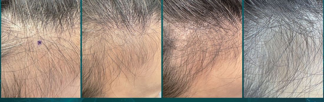 女士前額髮際線，第 1、16、30、90 天 / Female frontal hairline, day 1, 16, 30, 90