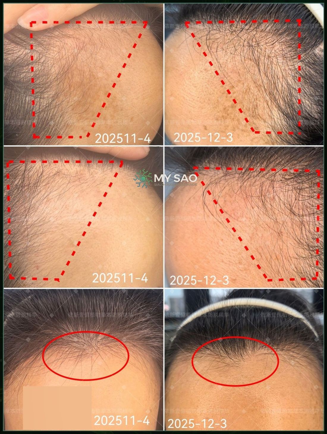 女士 · 前額與頭頂 / Woman · forehead and crown