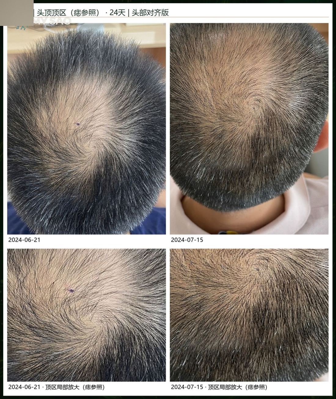 頂區 · 以痣定位 · 24 天（1/1）/ Crown · aligned on a mole · 24 days