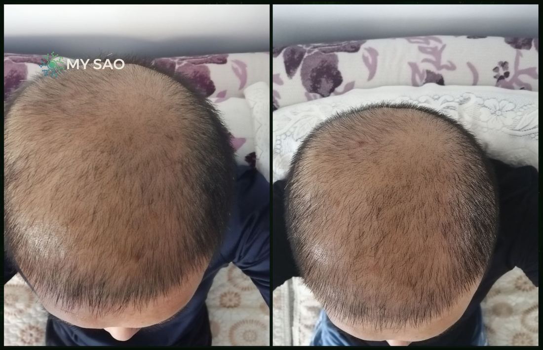 頂區俯拍 · 使用前後（1/1）/ Crown from above · before and after