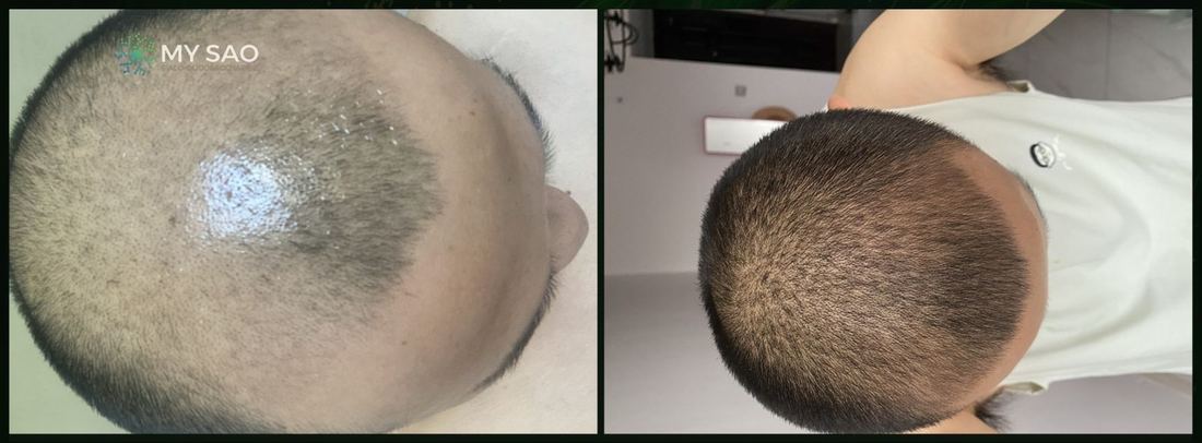 頂區 · 使用前後（1/1）/ Crown · before and after