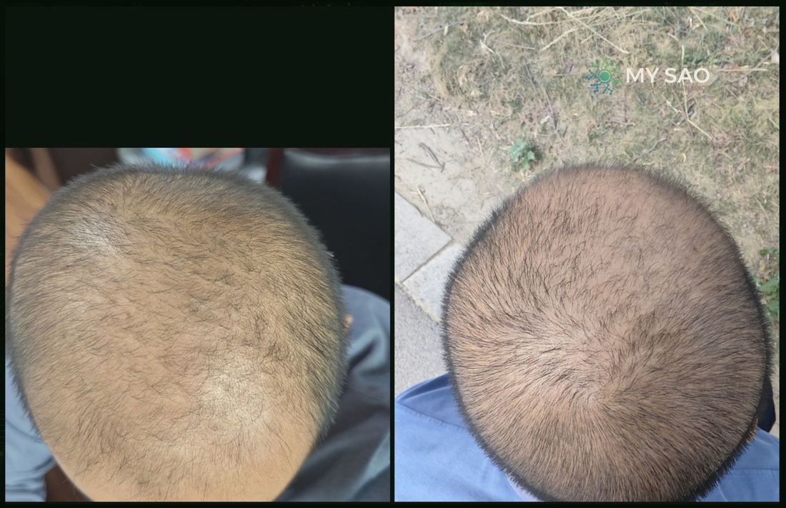 頂區與前額 · 使用前後（1/1）/ Crown and forehead · before and after